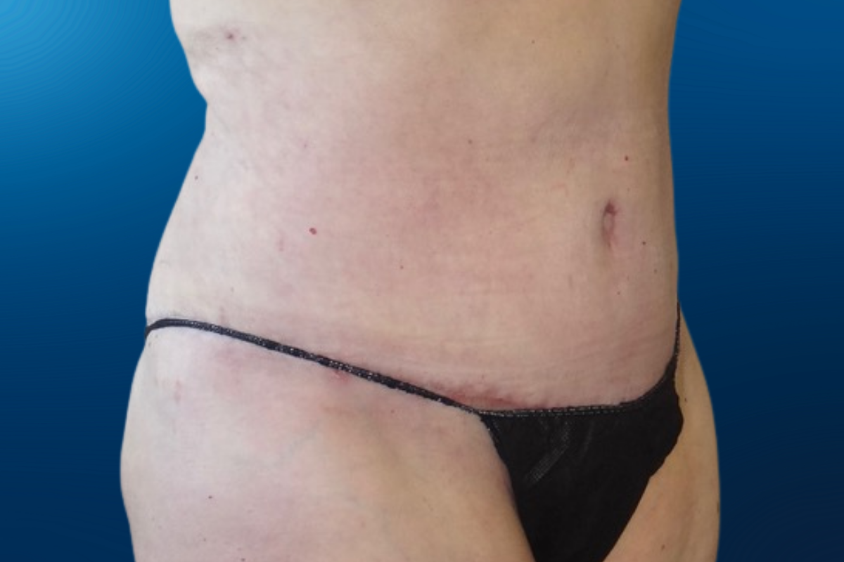 Abdominoplasty 4F