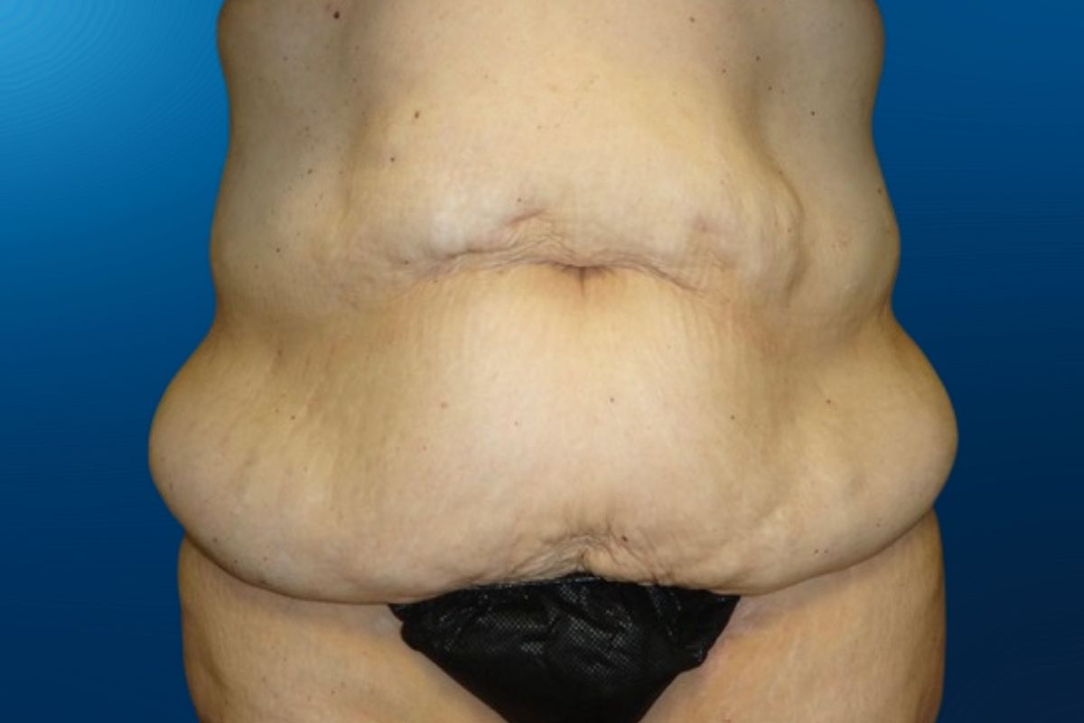 Abdominoplasty 5A
