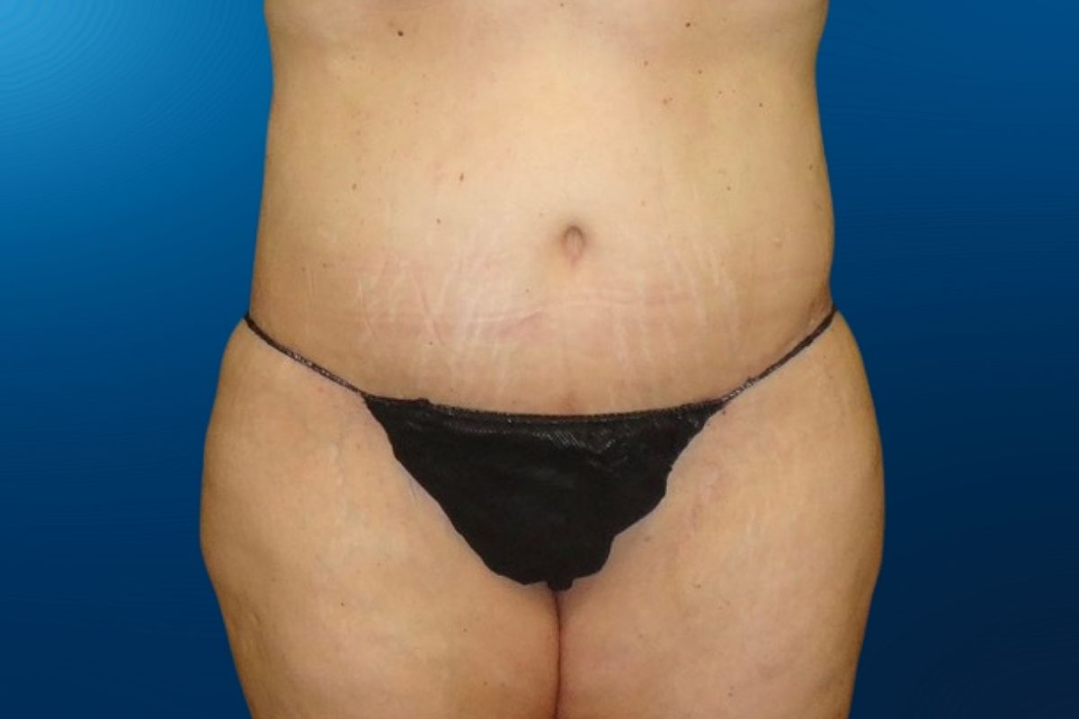 Abdominoplasty 5B