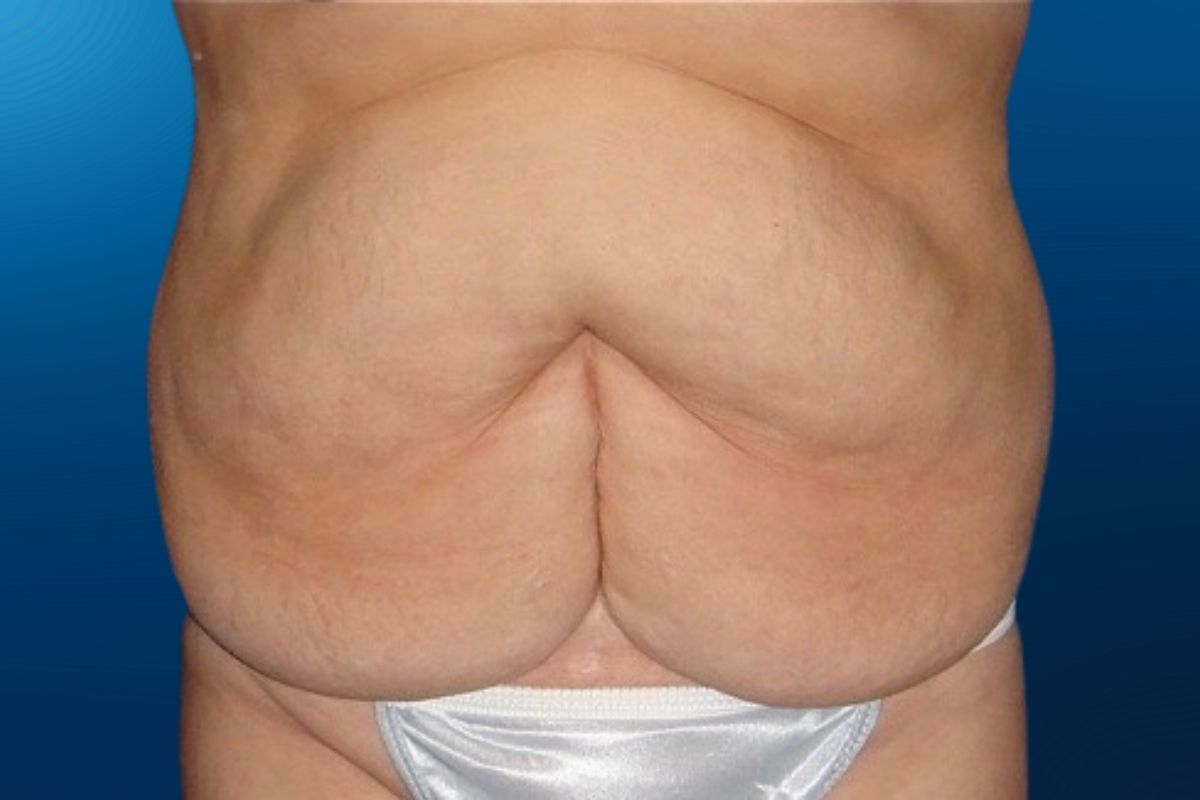Abdominoplasty 8A