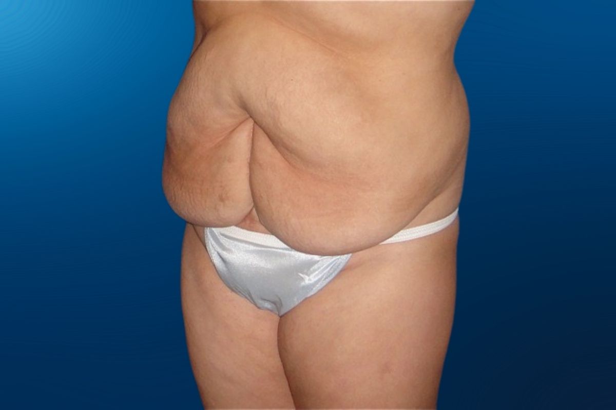 Abdominoplasty 8C