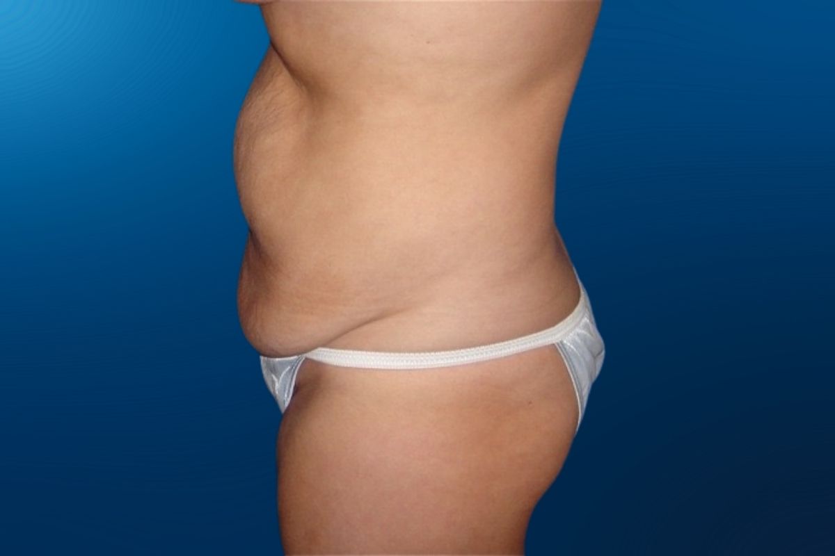 Abdominoplasty 8E