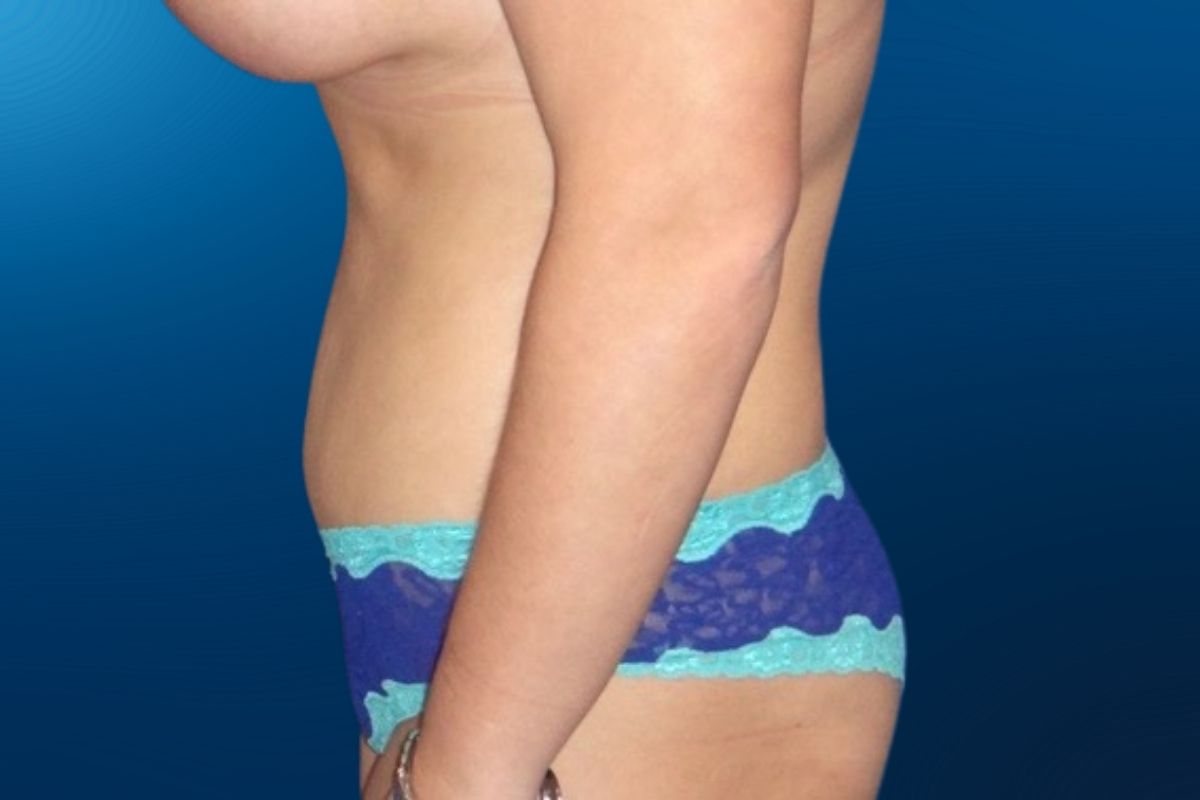 Abdominoplasty 8F