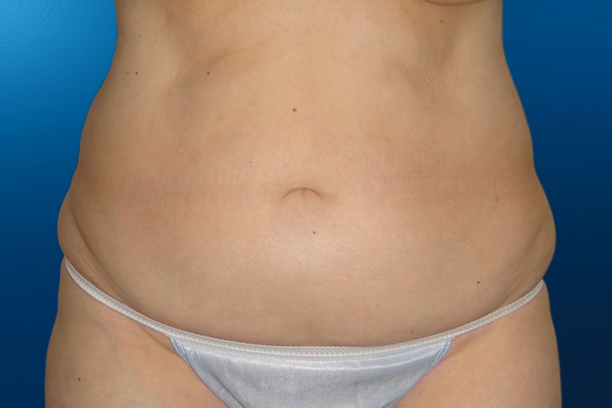 Abdominoplasty 9A
