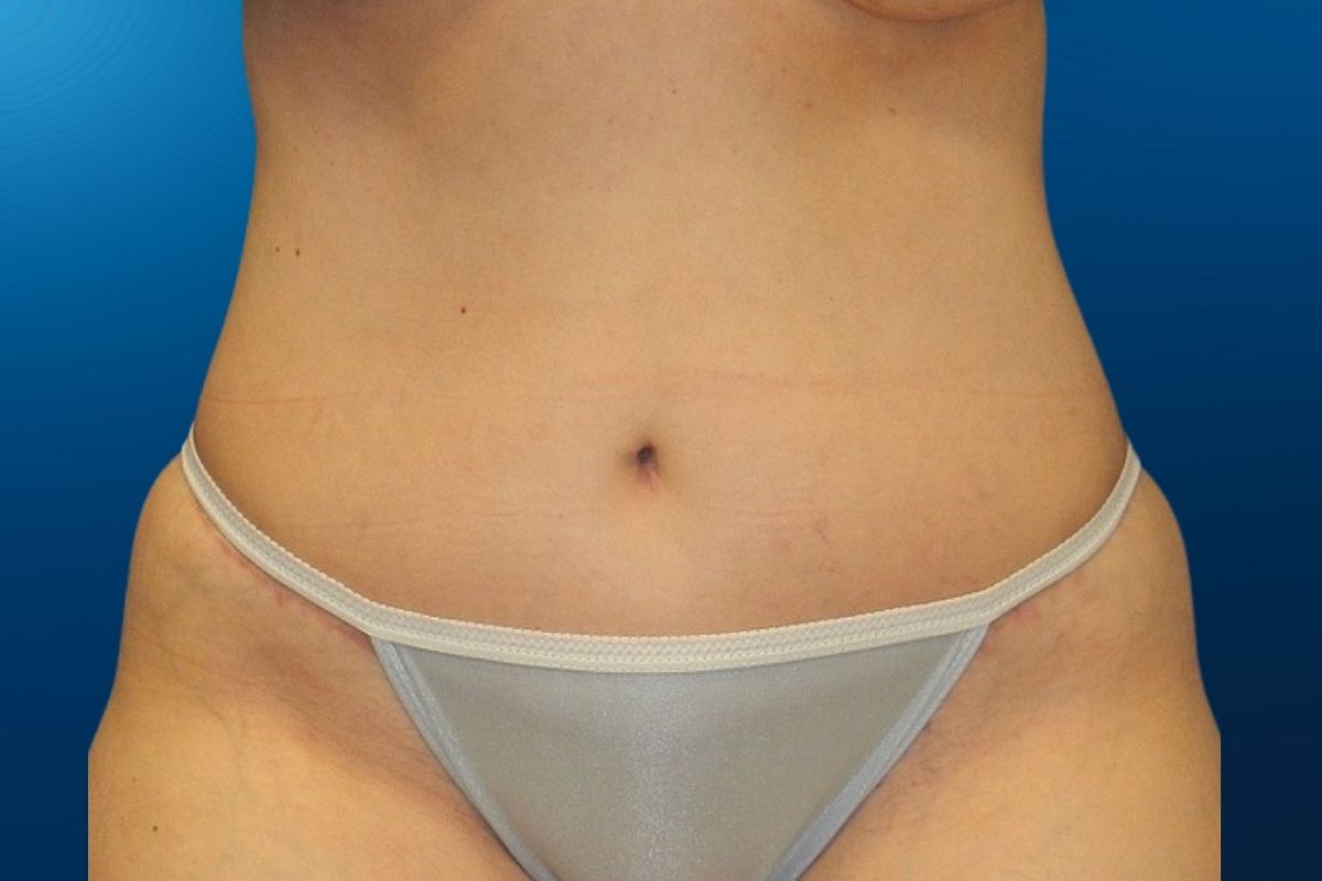 Abdominoplasty 9B