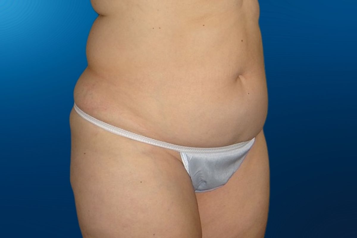 Abdominoplasty 9C