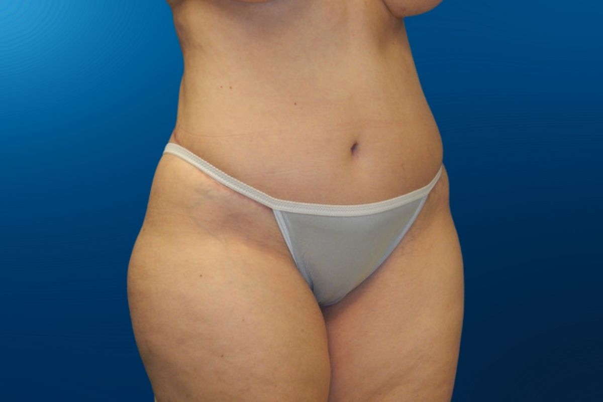 Abdominoplasty 9D