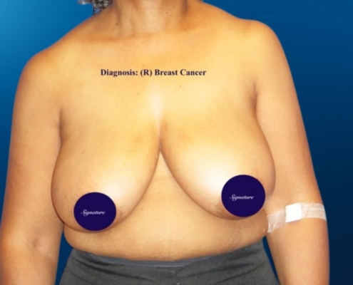 Breast Reconstruction 11A