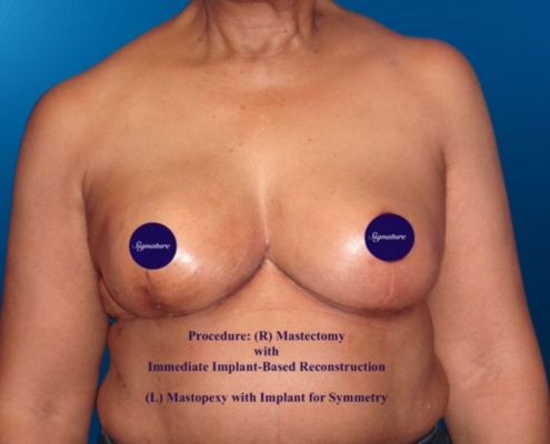 Breast Reconstruction 11B