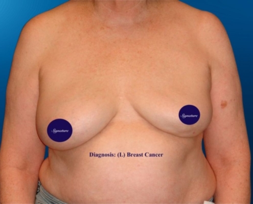 Breast Reconstruction 13A