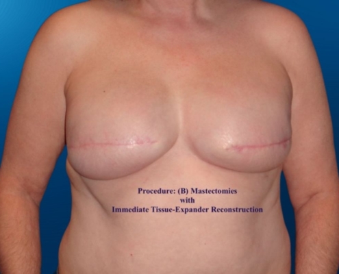 Breast Reconstruction 13B