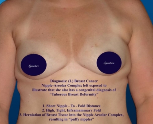 Breast Reconstruction 18A
