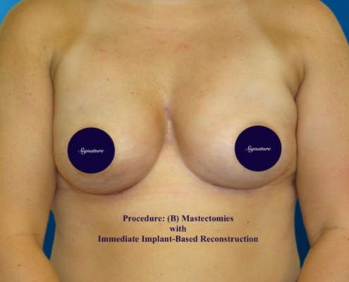 Breast Reconstruction 18B