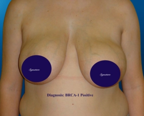 Breast Reconstruction 19A