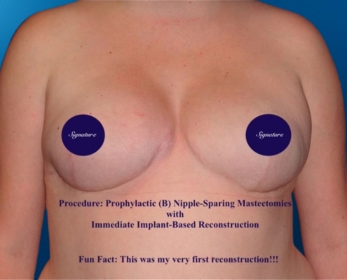 Breast Reconstruction 19B