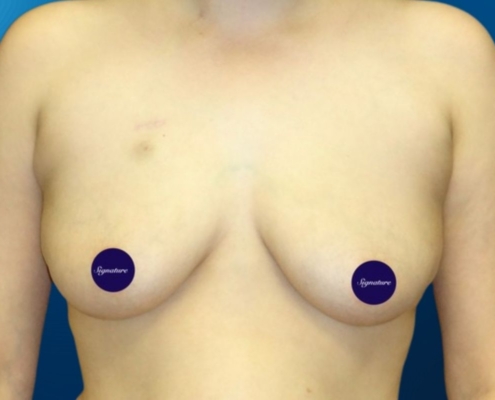 Breast Reconstruction 5A