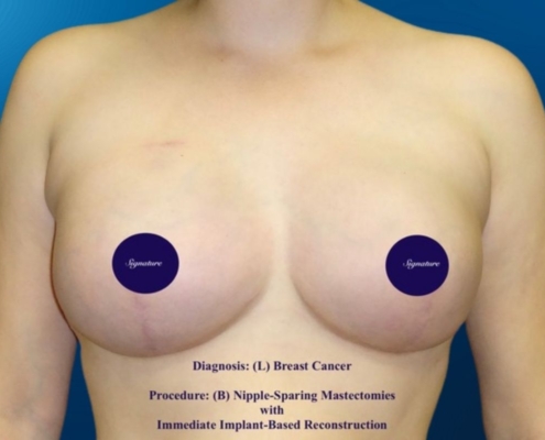 Breast Reconstruction 5B
