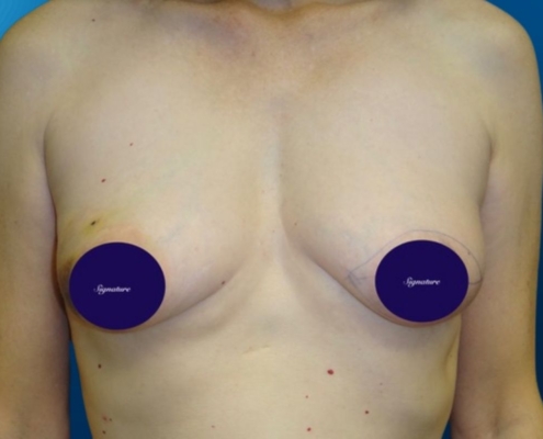 Breast Reconstruction 7A
