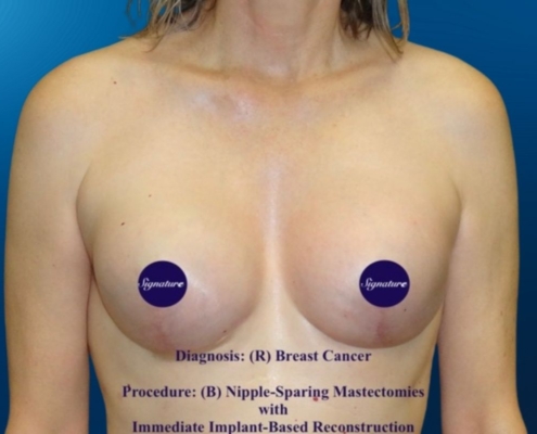 Breast Reconstruction 7B