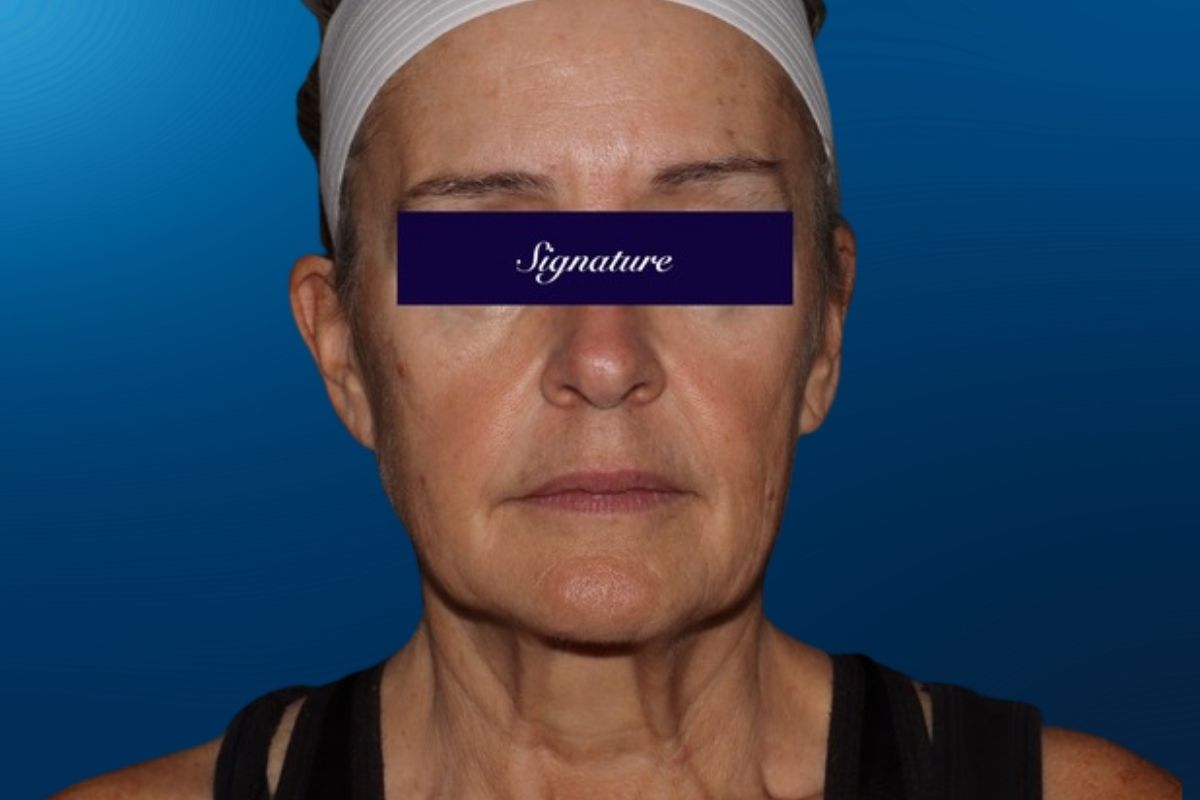 Facelift 1A