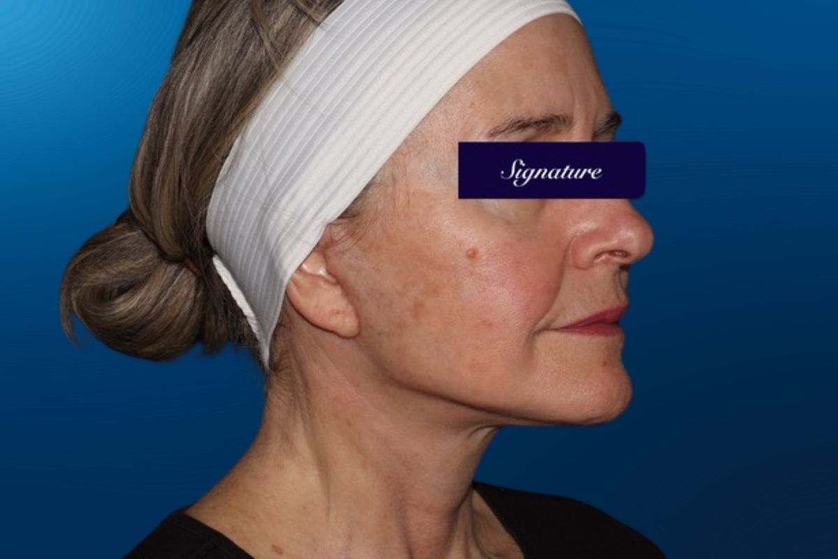 Facelift 1D