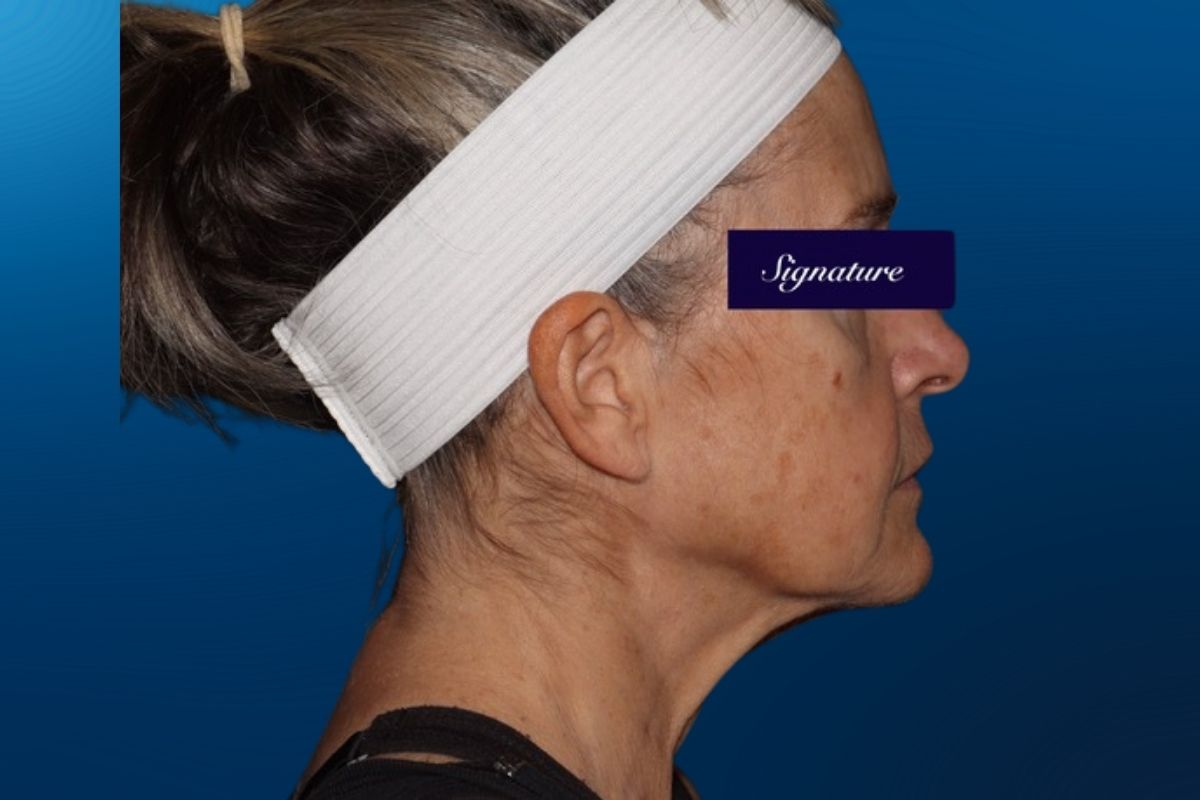 Facelift 1E