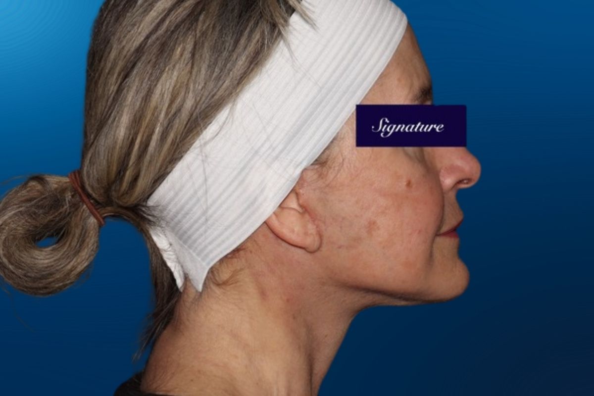 Facelift 1F