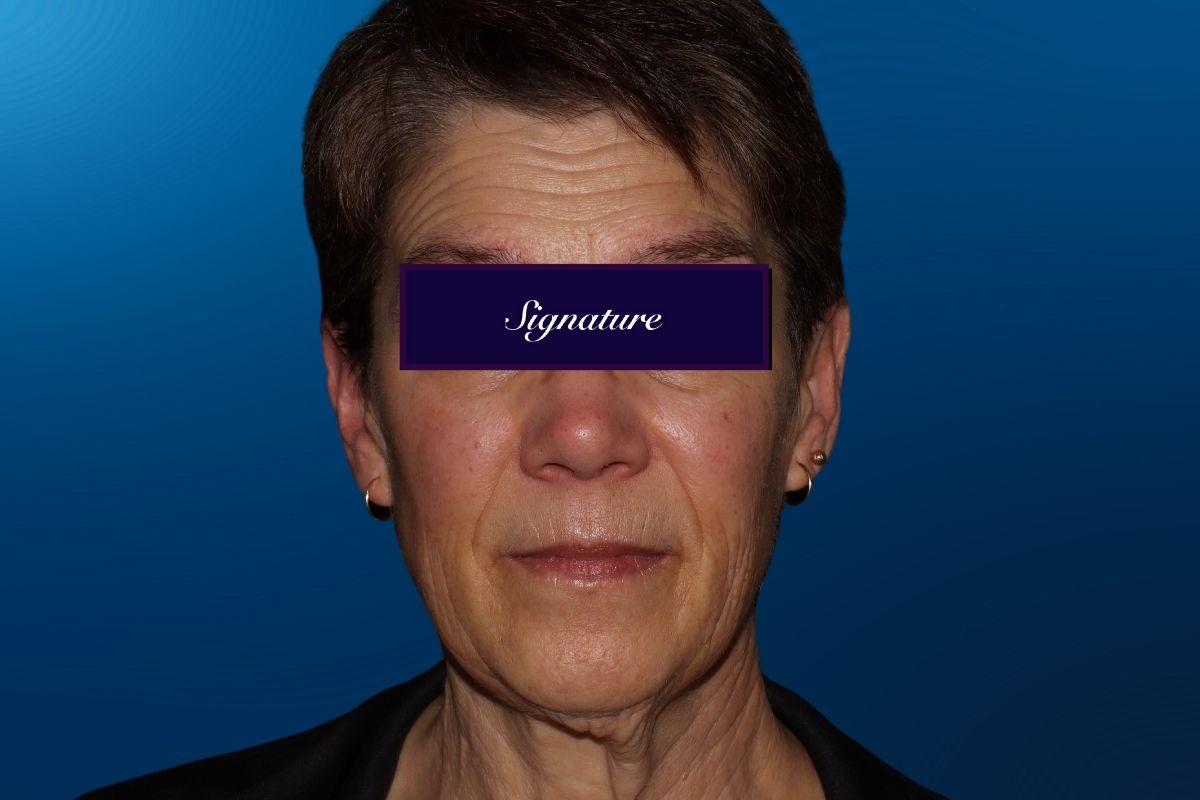 Facelift 2A