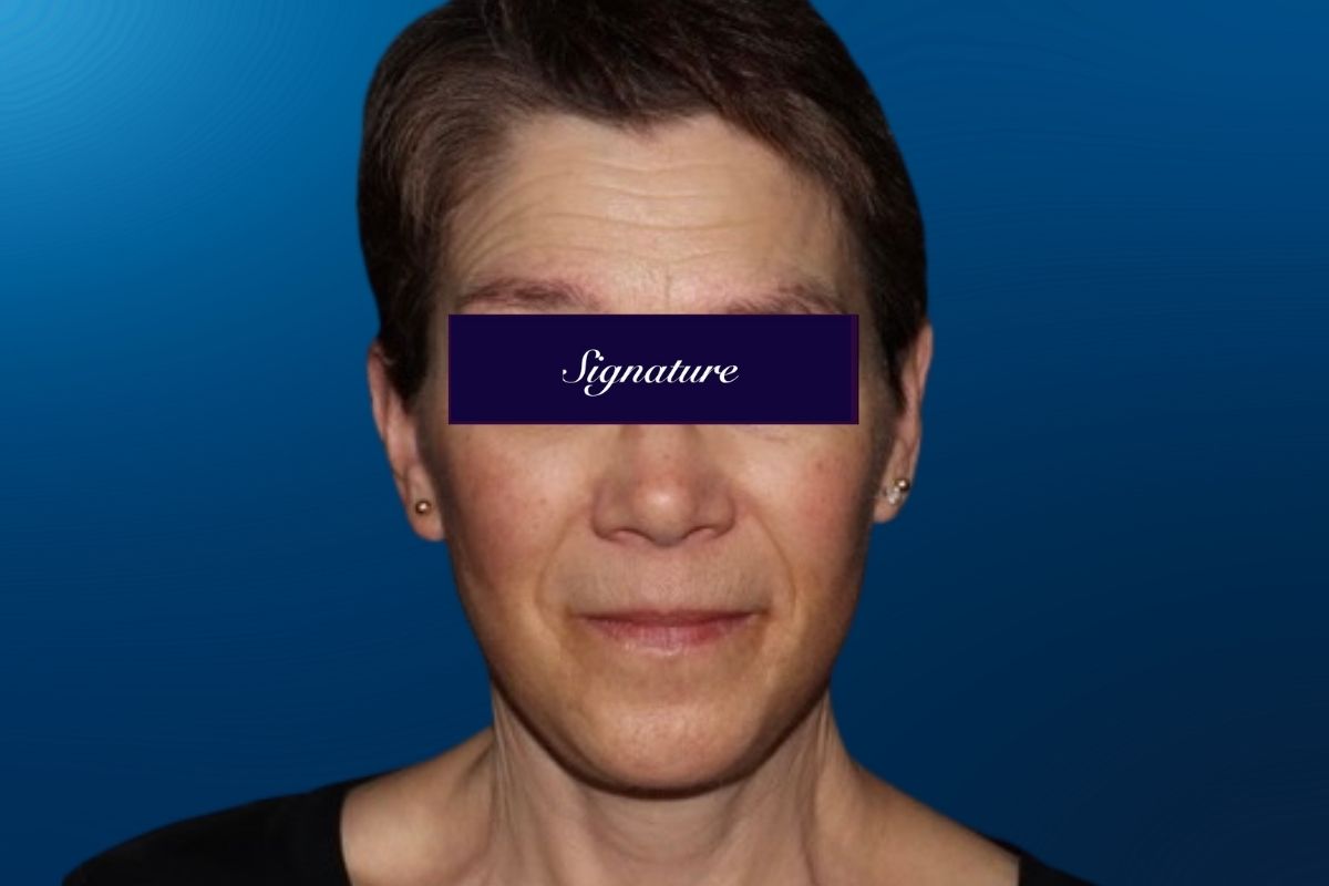 Facelift 2B