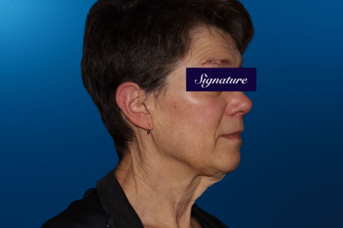 Facelift 2C