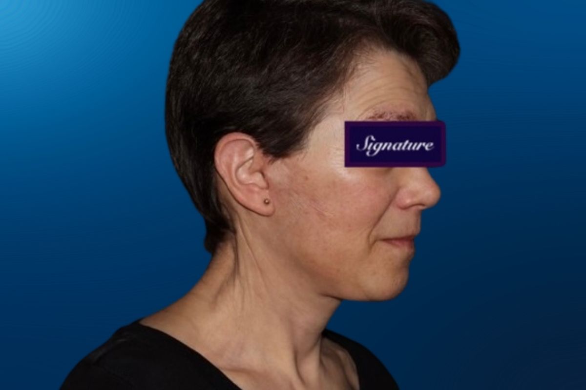 Facelift 2D
