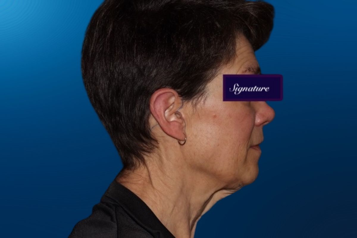 Facelift 2E
