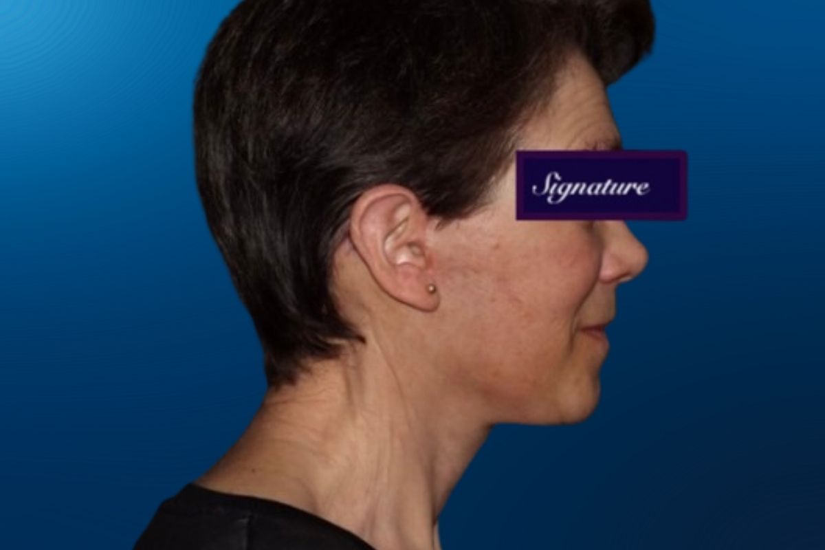 Facelift 2F