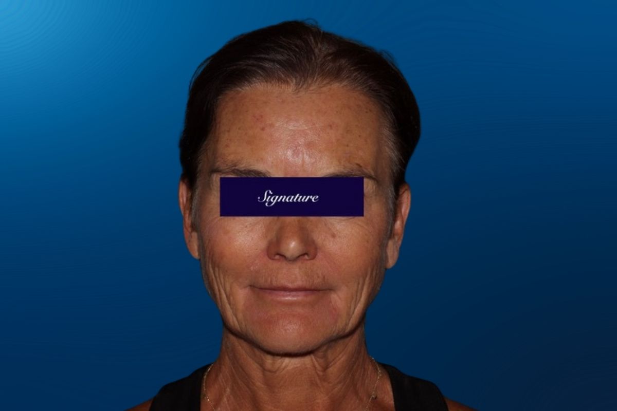 Facelift 3A