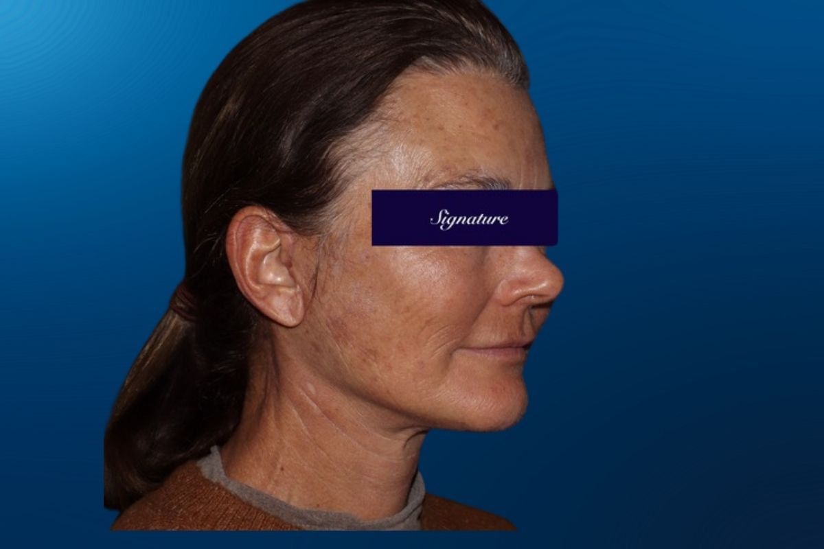 Facelift 3D
