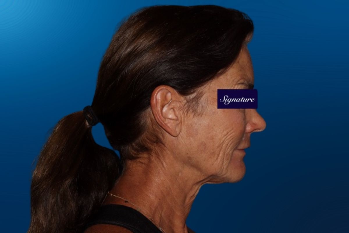 Facelift 3E