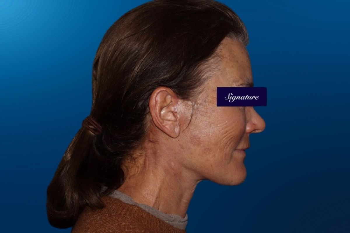 Facelift 3F