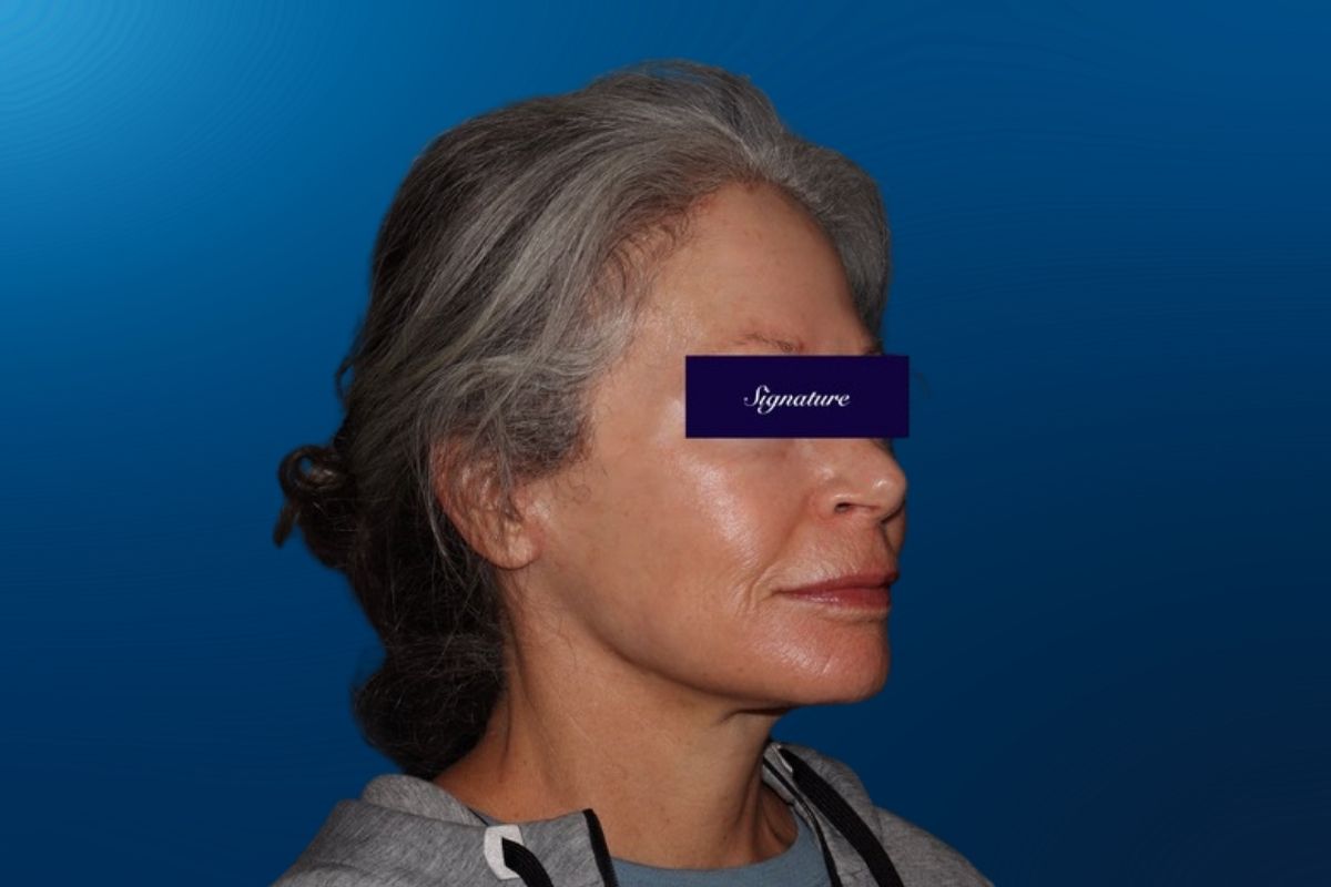 Facelift 5D