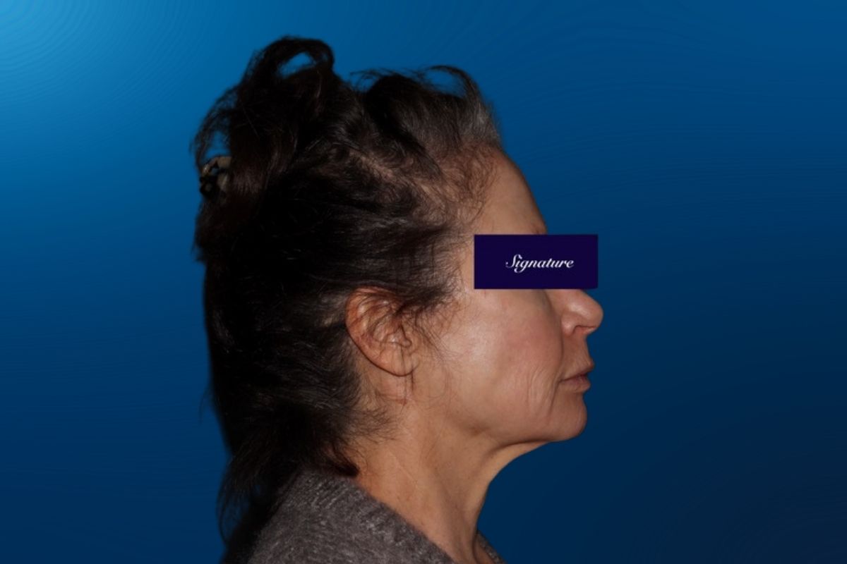 Facelift 5E