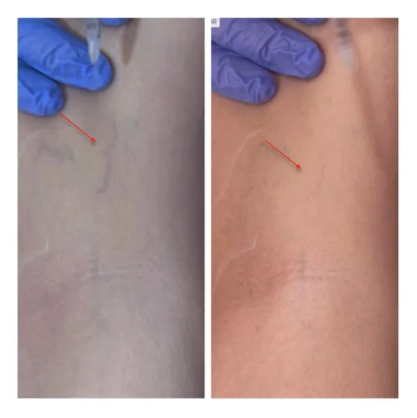 Sclerotherapy for spider vein treatment at Signature Plastic Surgery in Jackson Hole, WY